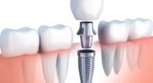 Impianti dentali: i vantaggi